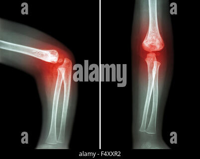 Rheumatoid arthritis , Gouty arthritis ( film x-ray child 's elbow with arthritis at elbow ) ( Side and front view , Lateral and Stock Photo