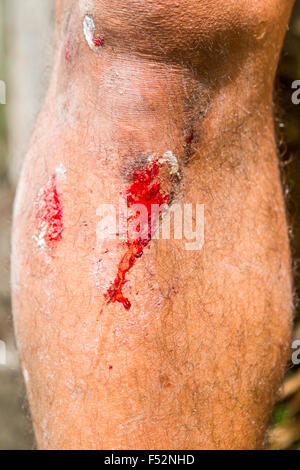 A close-up view of a human leg showing multiple fresh wounds with visible red blood. The skin is light-toned and covered with fine body hair. One prominent laceration runs diagonally, with blood Stock Photo