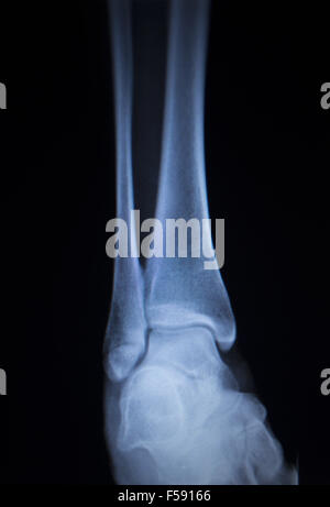 X-ray orthopedic medical CAT scan of painful ankle foot injury in traumatology hospital clinic. Stock Photo