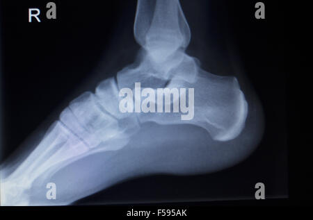 X-ray orthopedic medical CAT scan of painful foot injury in traumatology hospital clinic. Stock Photo