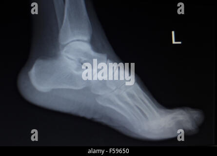 X-ray orthopedic medical CAT scan of painful foot injury in traumatology hospital clinic. Stock Photo