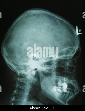 film x-ray skull of adult woman,  Medical,Science and Healthcare concept, black copy spacearea,side view Stock Photo