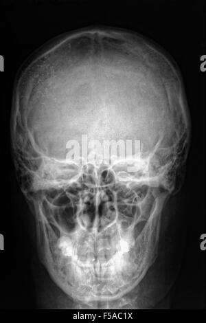 film x-ray skull of human, Medical,Science and Healthcare concept, black copy spacearea,front view Stock Photo