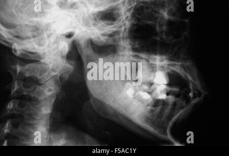 film x-ray skull of human,  Medical,Science and Healthcare concept, black copy spacearea,side view Stock Photo