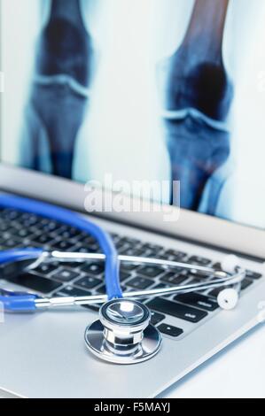 Modern orthopedics. Acoustic stethoscope on an  laptop computer that displays an anteroposterior X-Ray image of knees Stock Photo