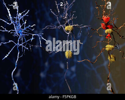 Alzheimer's disease. Computer illustration of a healthy neuron (left), a neuron with amyloid plaques (yellow, centre), and a