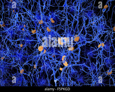Alzheimer's disease. Computer illustration of amyloid plaques amongst neurons. Amyloid plaques are characteristic features of