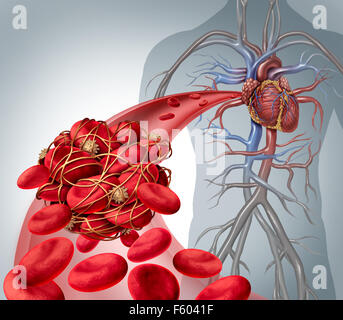 Blood clot risk and clot or thrombosis medical illustration symbol as a group of human blood cells clumped together by sticky platelets and fibrin creating a blockage in an artery or vein leading to the heart. Stock Photo