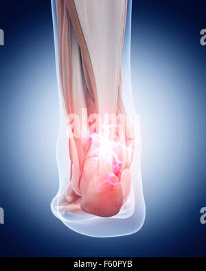 medical 3d illustration of a painful achilles tendon Stock Photo