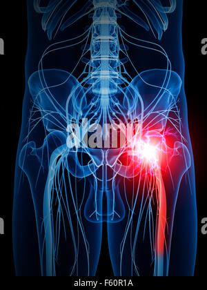 medically accurate illustration of a painful sciatic nerve Stock Photo