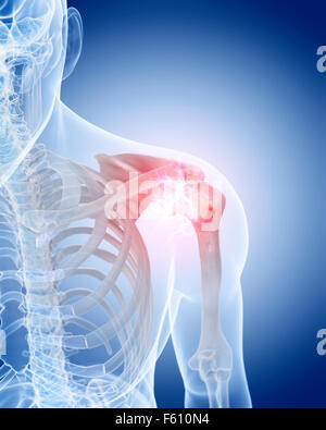 medically accurate illustration of a painful shoulder Stock Photo