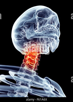 medically accurate illustration - painful cervical spine Stock Photo