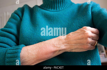 A huge red welt (wheal) on a woman's forearm that is swollen and itchy. Stock Photo