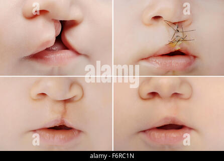 4 closeup pictures of baby with lip and palate cleft before and after surgery Stock Photo