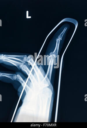 X-Ray image of human hand with stick for fracture Stock Photo