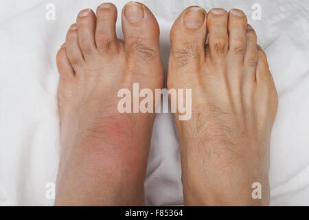 A pair of feet with the left foot inflamed and swollen with gout. Stock Photo