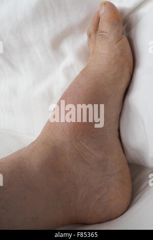 A swollen left foot with gout Stock Photo - Alamy