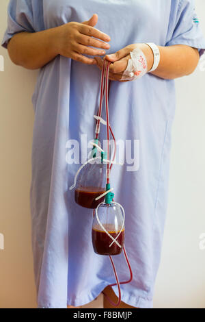 Drainage tubes after surgery. Stock Photo