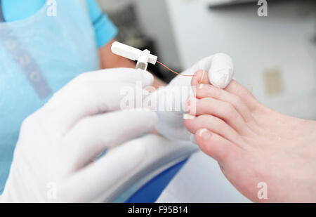 Rheumatism feet treatment by pedicure in closeup Stock Photo