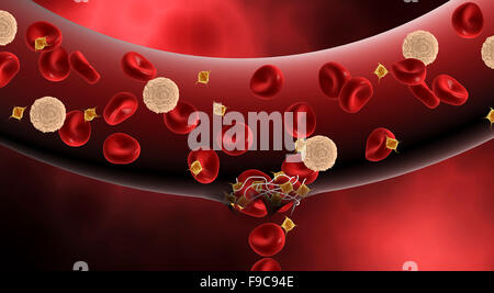 Blood clotting inside artery. Stock Photo