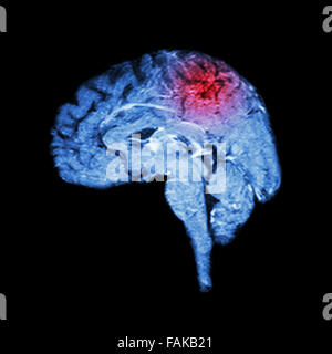 Magnetic Resonance Imaging ( MRI ) of brain and Stroke ( Medical , science and healthcare concept ) Stock Photo