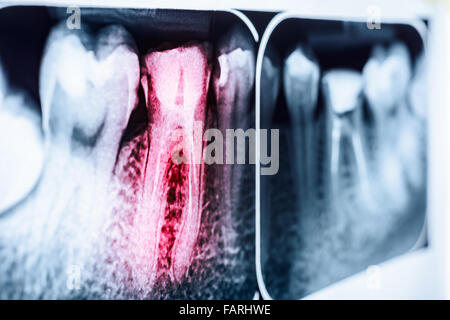 Pain Of Tooth Decay On Teeth X-Ray Stock Photo