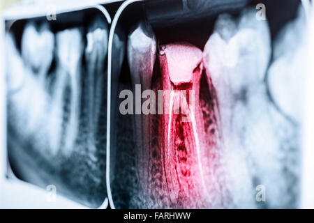 Pain Of Tooth Decay On Teeth X-Ray Stock Photo