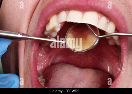 patient open mouth before oral inspection with hook and mirror near by Stock Photo
