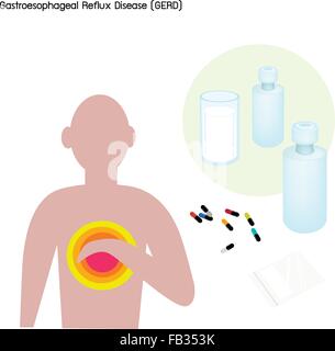 Medical Concept, Illustration of Heartburn and Gastroesophageal Reflux Disease or GERD Caused by Stomach Acid Coming Up From The Stock Vector