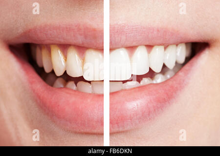 Perfect smile before and after bleaching procedure whitening of young