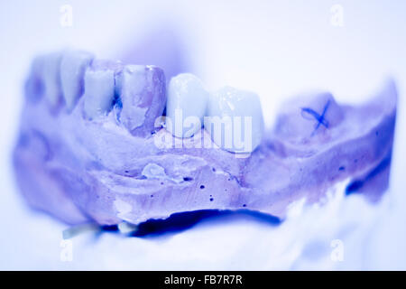 Dental prosthetics clay tooth mold in dentists photo. Stock Photo