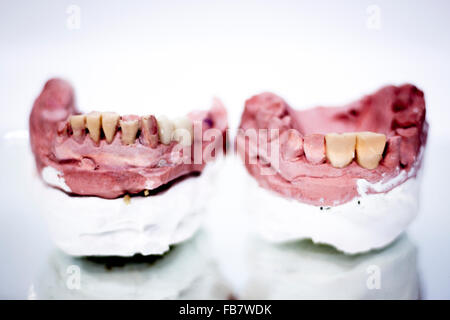 Dental prosthetics clay tooth mold in dentists photo. Stock Photo