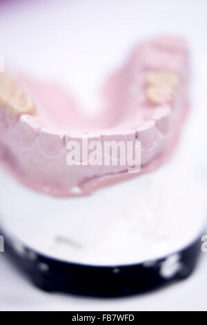 Dental prosthetics clay tooth mold in dentists photo. Stock Photo