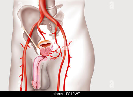 PROSTATIC ADENOMA Stock Photo