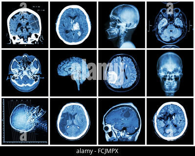Collection of brain disease ( CT scan and MRI of brain : show cerebral infarct , intracerebral hemorrhage , brain tumor , basal Stock Photo