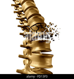 Spinal Fracture and traumatic vertebral injury medical concept as a human anatomy spinal column with a broken burst vertebra due to compression or other osteoporosis back disease on a white background. Stock Photo