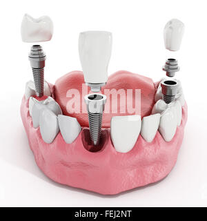 Illustration of teeth showing dental implant structure Stock Photo