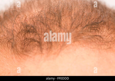 man controls hair loss stress alopecia cancer treatment Stock Photo