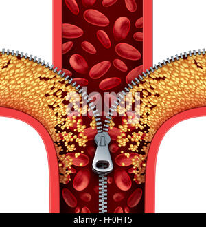 Atherosclerosis therapy cleaning arteries concept as a zipper opening up plaque buildup in a blocked artery as a symbol of medical treatment cleaning clogged veins as a metaphor for removing cholesterol. Stock Photo