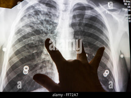 An abnormal digital chest x-ray is shown on the screen in the NHS’s ...