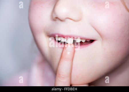 Child / five year old Child's loose front milk teeth / central incisor tooth which is about to fall out from the gum and mouth. Stock Photo