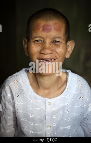 Cambodian Buddhist nun with marks of cupping therapy on forehead Stock Photo
