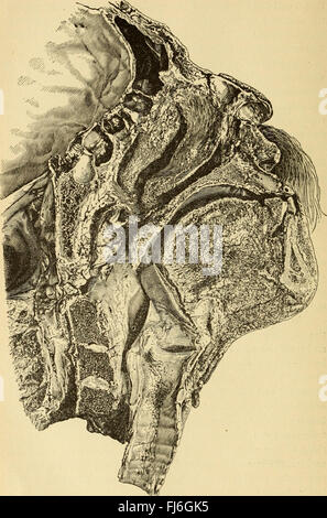 Diseases of the nose and throat; a text-book for students and practitioners (1893) Stock Photo