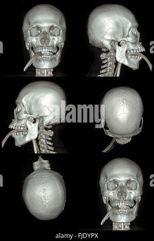 X-ray image of the skull computed tomography 3D Stock Photo