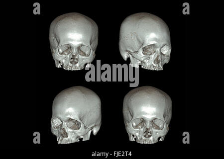 X-ray image of the skull computed tomography 3D Stock Photo