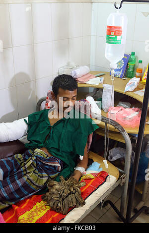 Bangladeshi Tree man Abdul Bajander rests after a surgery at Dhaka Medical College Hospital in Dhaka on Feb. 23, 2016. Stock Photo