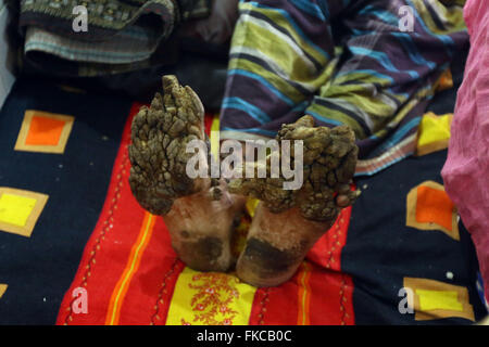 Bangladeshi Tree man Abdul Bajander rests after a surgery at Dhaka Medical College Hospital in Dhaka on Feb. 23, 2016. Stock Photo