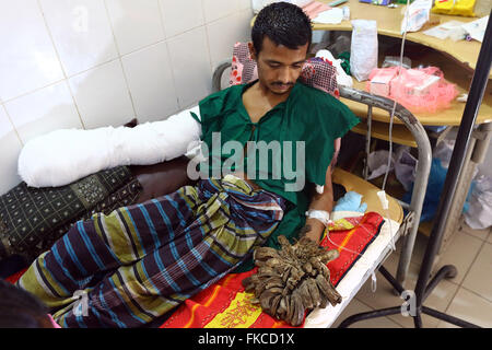 Bangladeshi Tree man Abdul Bajander rests after a surgery at Dhaka Medical College Hospital in Dhaka on Feb. 23, 2016. Stock Photo