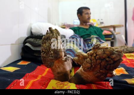 Bangladeshi Tree man Abdul Bajander rests after a surgery at Dhaka Medical College Hospital in Dhaka on Feb. 23, 2016. Stock Photo