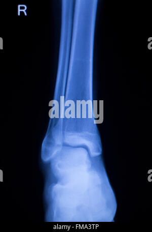 Shin, lower leg and ankle injury Traumatology medical x-ray Orthopedic test scan image. Stock Photo